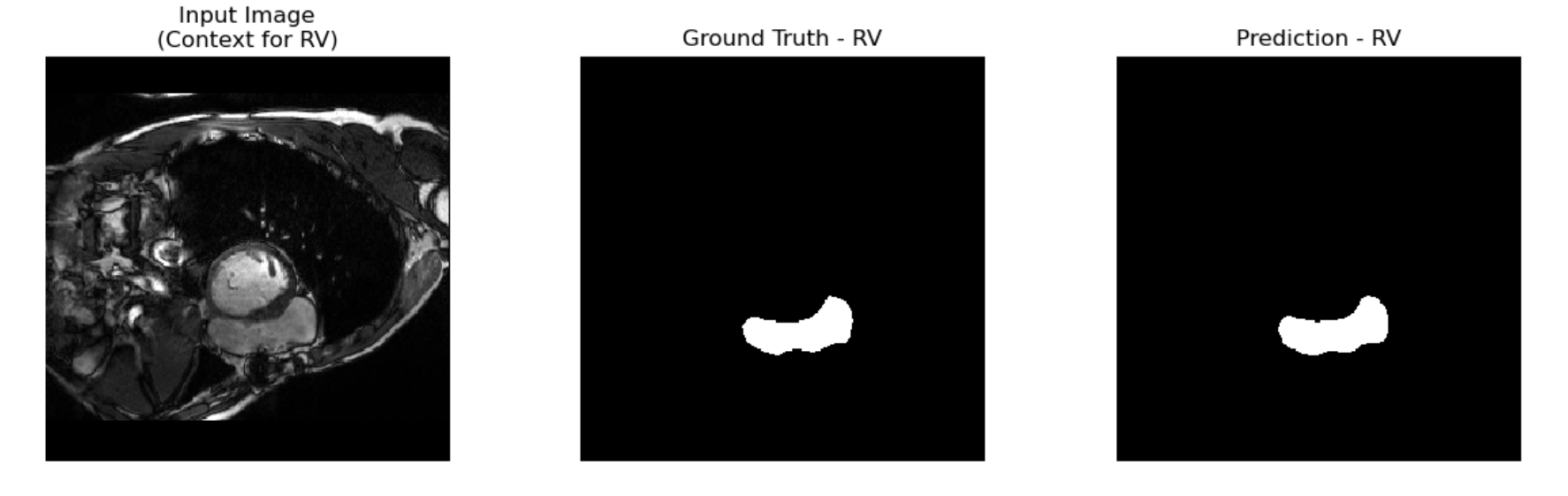 Attention U-Net Segmentation Example RV