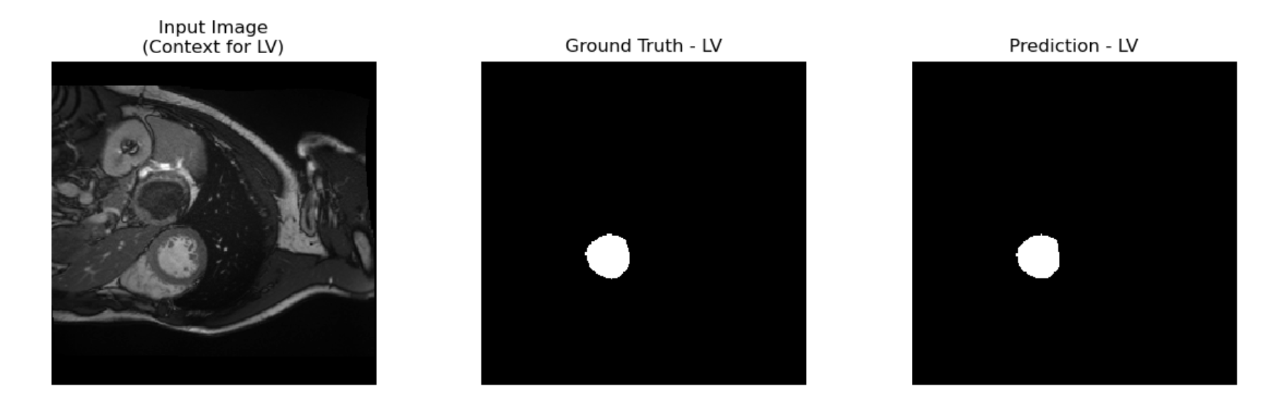 Baseline Segmentation Example LV
