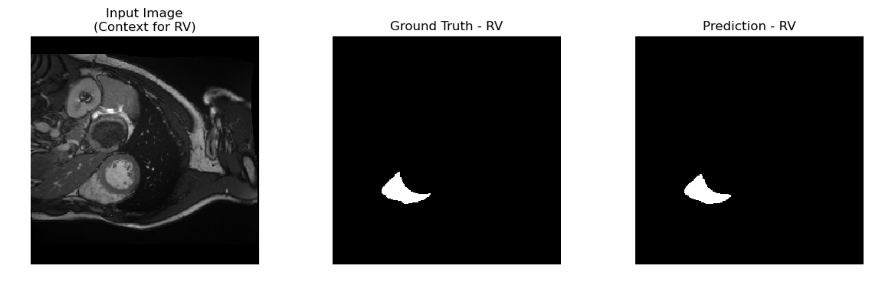 Baseline Segmentation Example RV