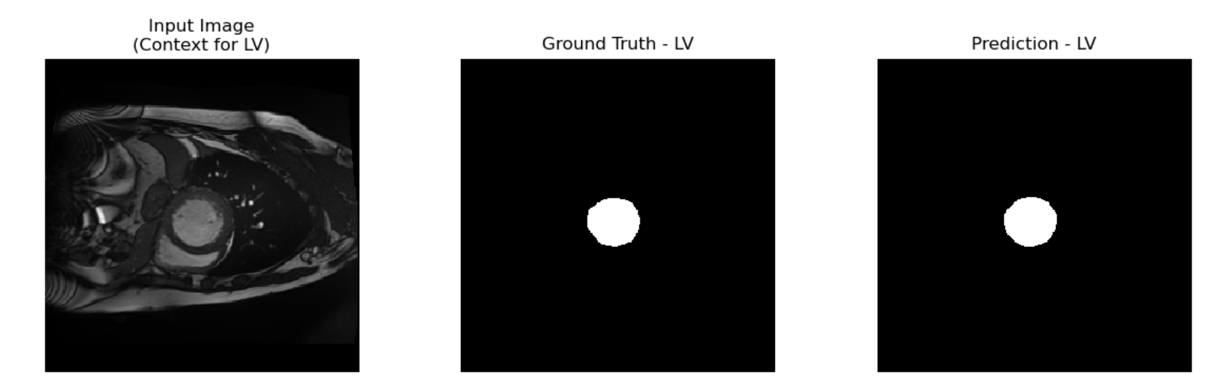 Baseline with Soft Dice Loss Segmentation Example LV