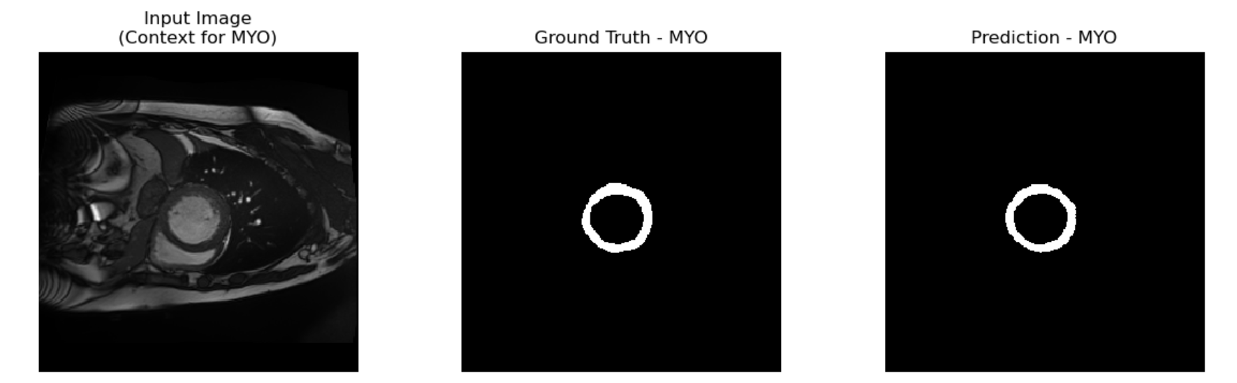 Baseline with Soft Dice Loss Segmentation Example MYO